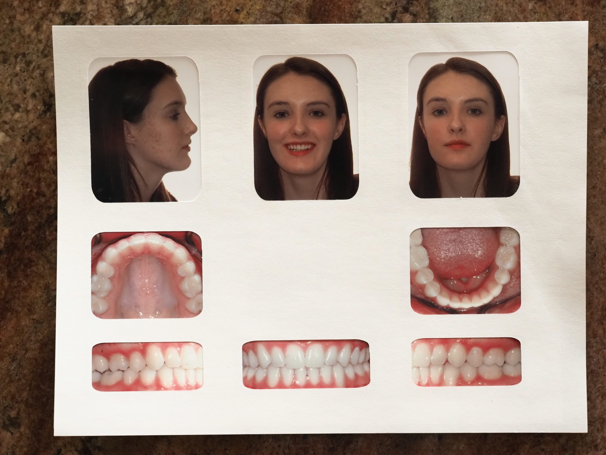 Missing 3 Permanent teeth Deep and Narrow (2)-min